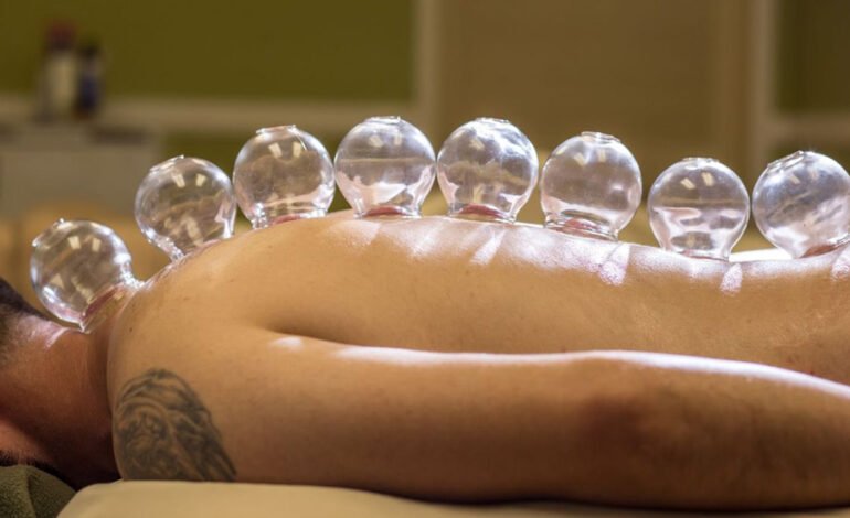  What is Cupping?